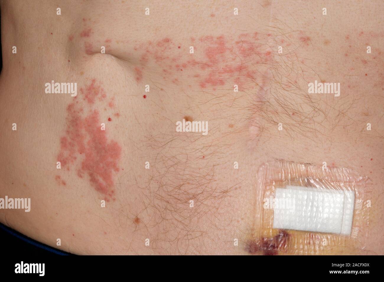 Allergic skin reaction to the adhesive used on operating theatre towels