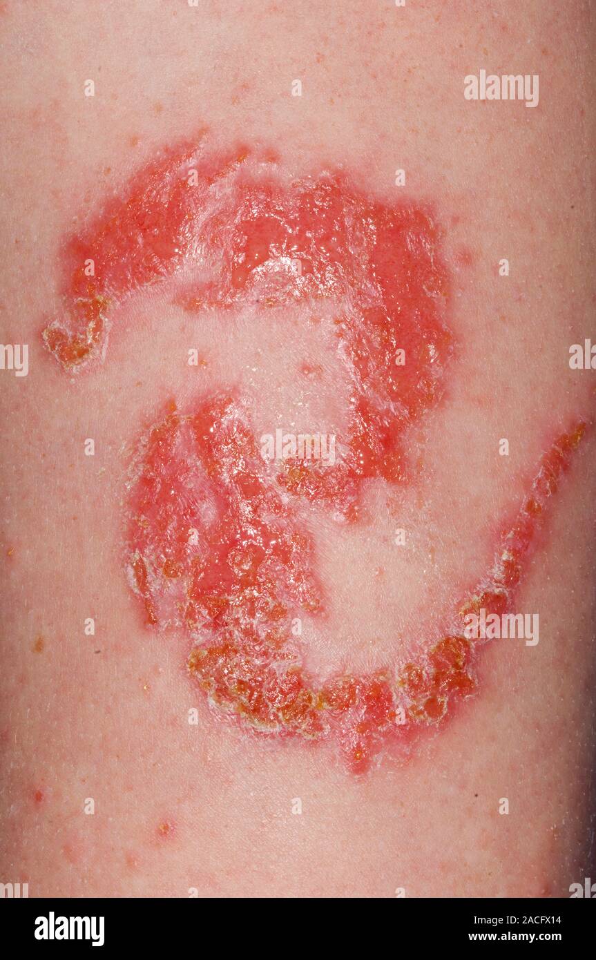 Allergic skin reaction to a henna tattoo on the arm, after ten days. This rash is a contact