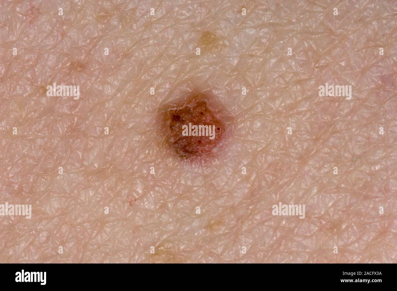 Inflamed seborrhoeic keratosis on the skin of an adult patient. This ...