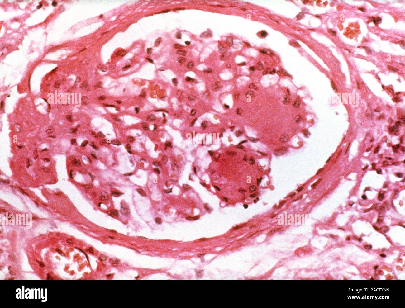 Glomerulonephritis. Light micrograph of tissue from a kidney in a case