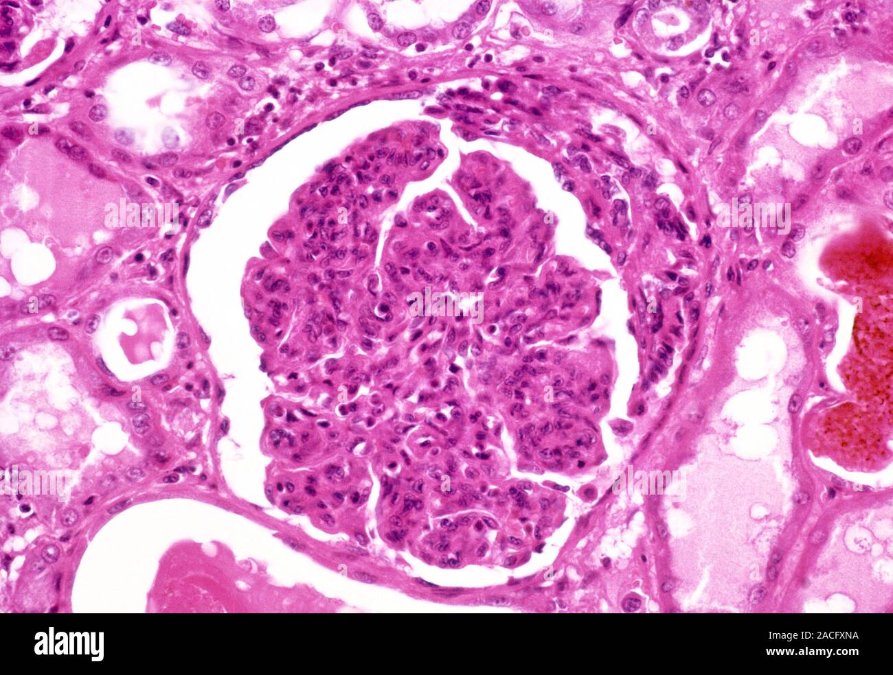 Glomerulonephritis. Light micrograph of tissue from a kidney in a case