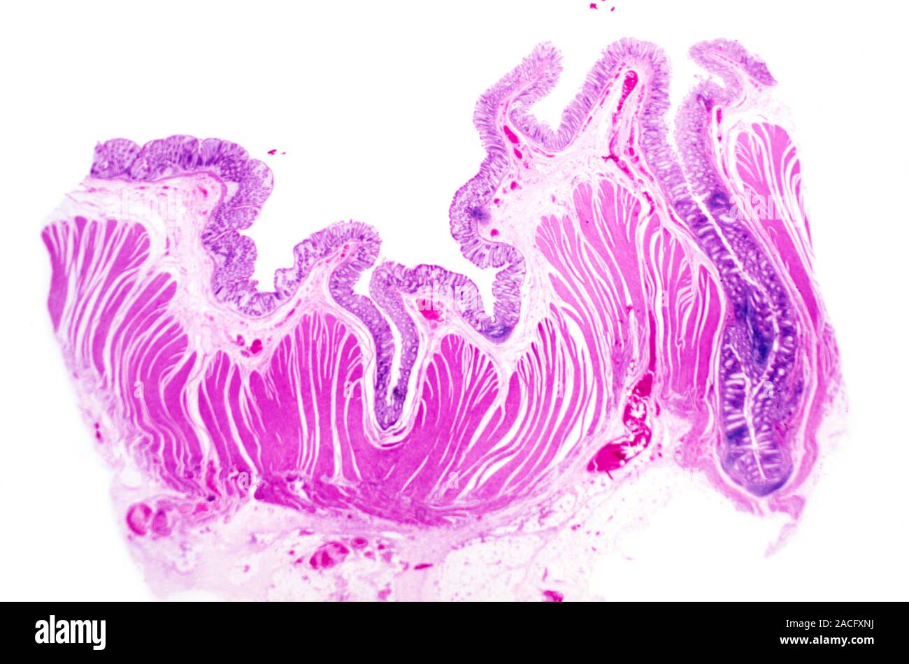 Diverticular disease. Light micrograph of tissue from an intestine in a