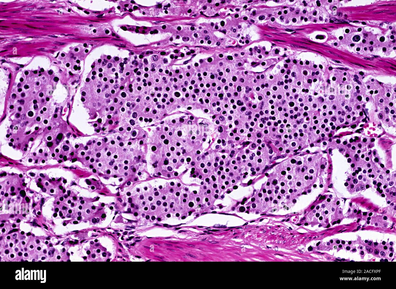Endocrine tumour. Light micrograph of a section through an apudoma