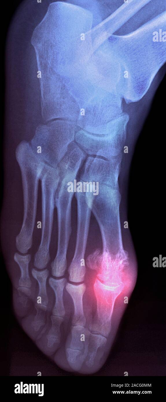 Coloured X-ray (top view) of the foot of a patient, showing the big toe ...