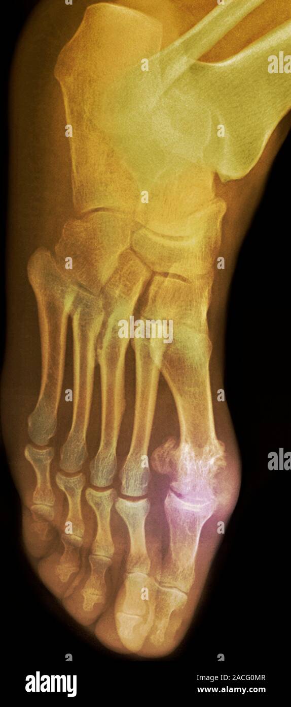 Coloured X-ray (top view) of the foot of a patient, showing the big toe ...