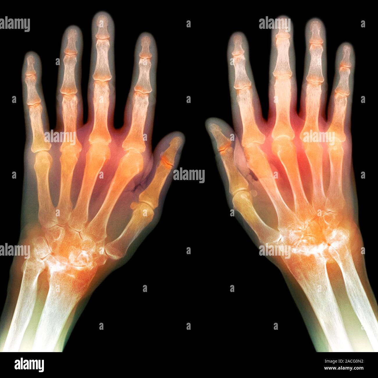 Coloured Xray (top view) of the hands of a patient, showing rheumatoid