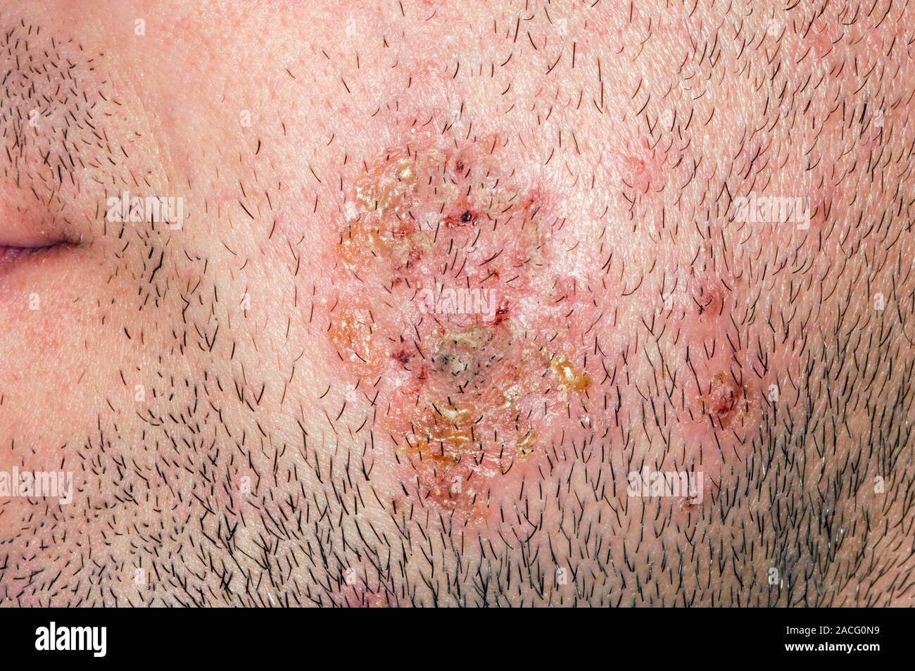 Impetigo on the unshaven cheek of a man. Impetigo is a bacterial skin
