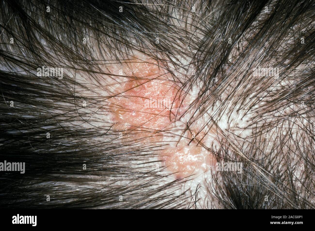 Sebaceous Birthmark Sebaceous naevus (birthmark) on the scalp of an adult patient. This ...