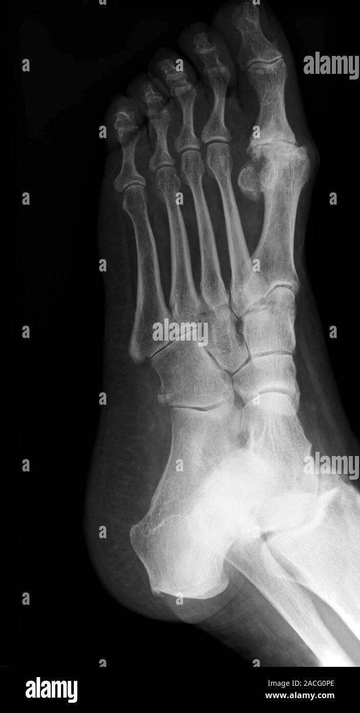 Xray (oblique view) of the left foot of a patient, showing