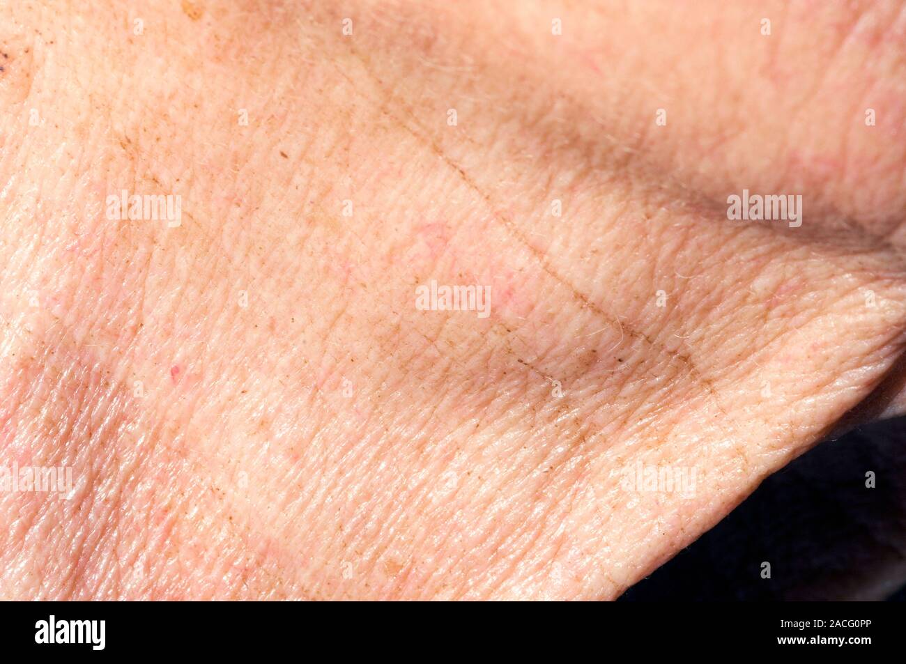 Closeup of a lump on the neck of an elderly female patient, a