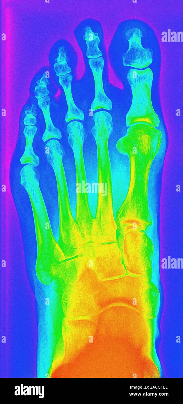 Normal left foot, coloured X-ray Stock Photo - Alamy