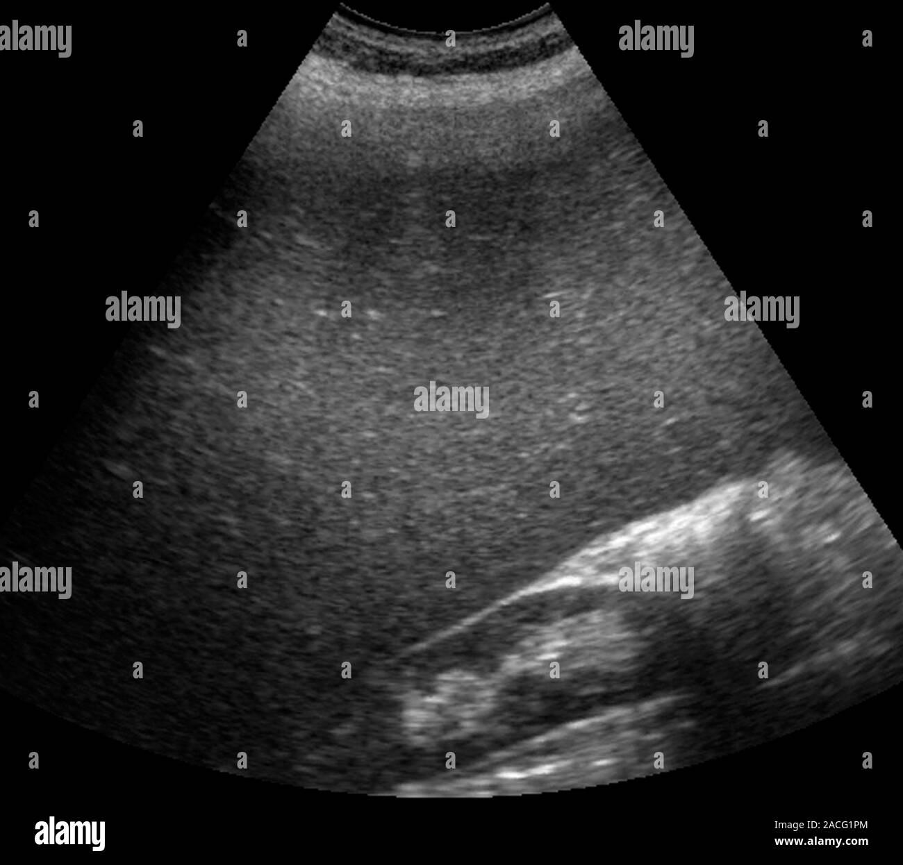 Enlarged spleen. Ultrasound scan of an enlarged spleen (bottom right