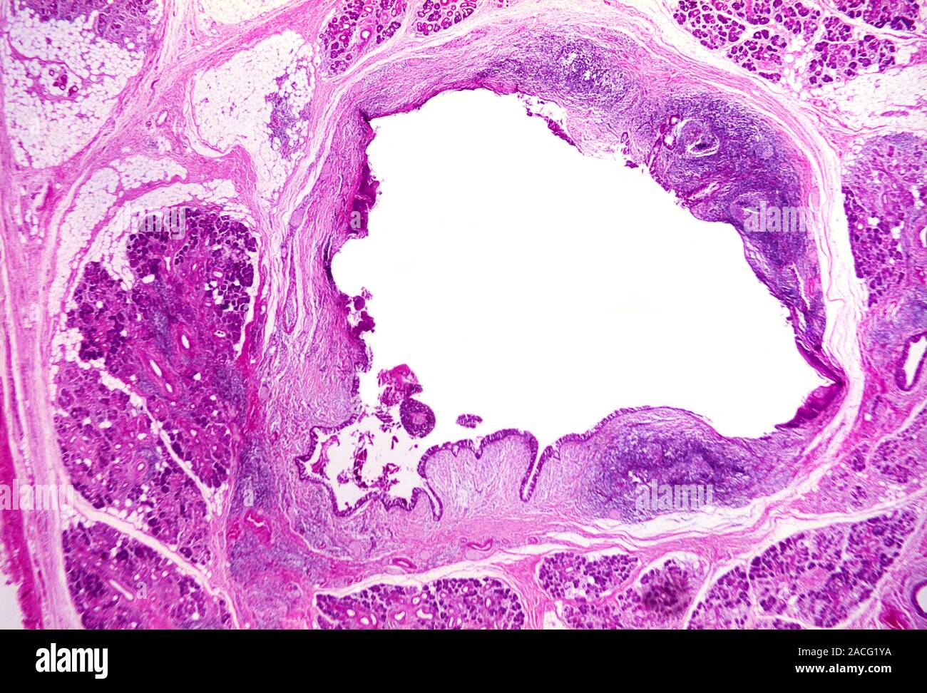 Inflamed salivary gland. Light micrograph of a section through a