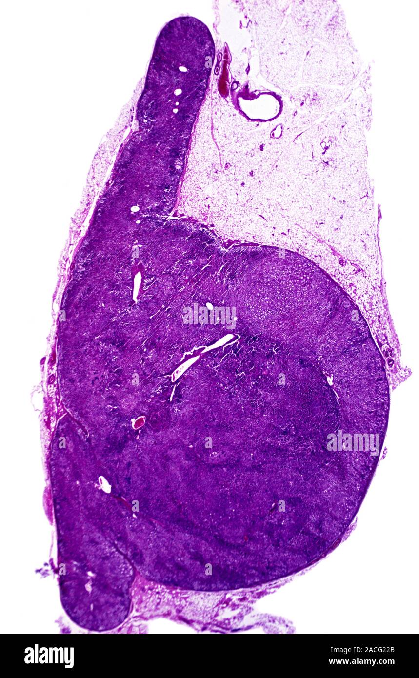 Adrenal hyperplasia. Light micrograph of a section through an adrenal