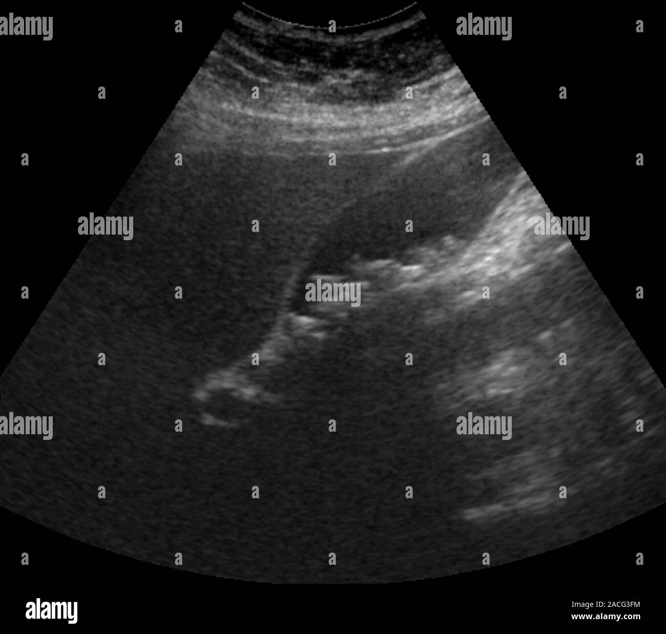 Gallstones Ultrasound Scan Of A Large Gallstone Pale Grey In The