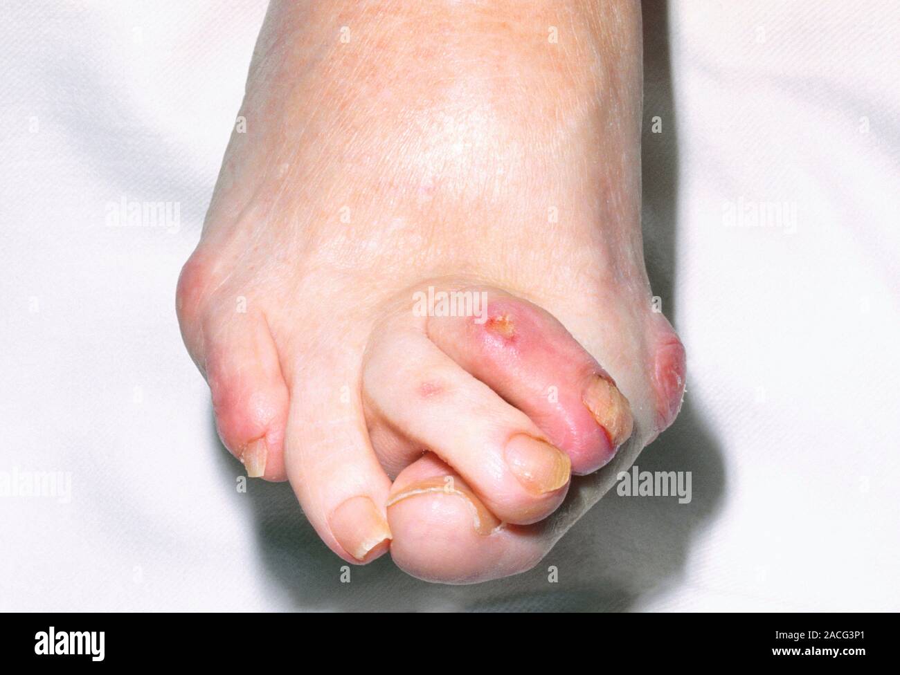 Severe bunion. Foot of patient with a severe bunion (hallux valgus ...