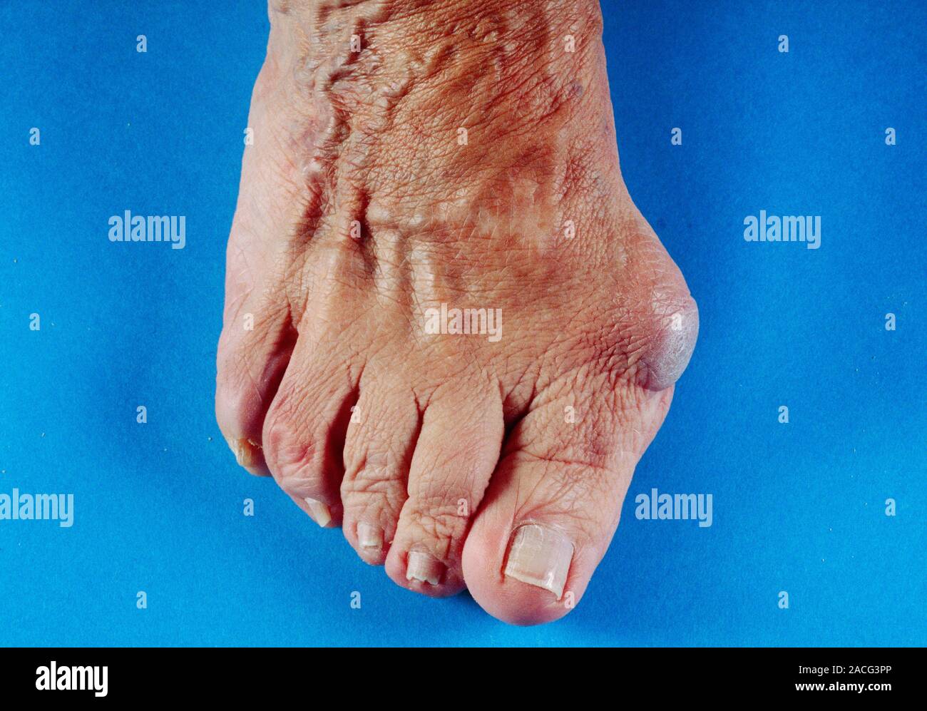 Bunions Foot Of A Patient With Bunions hallux Valgus Centre Left bunions-foot-of-a-patient-with-bunions-hallux-valgus-centre-left