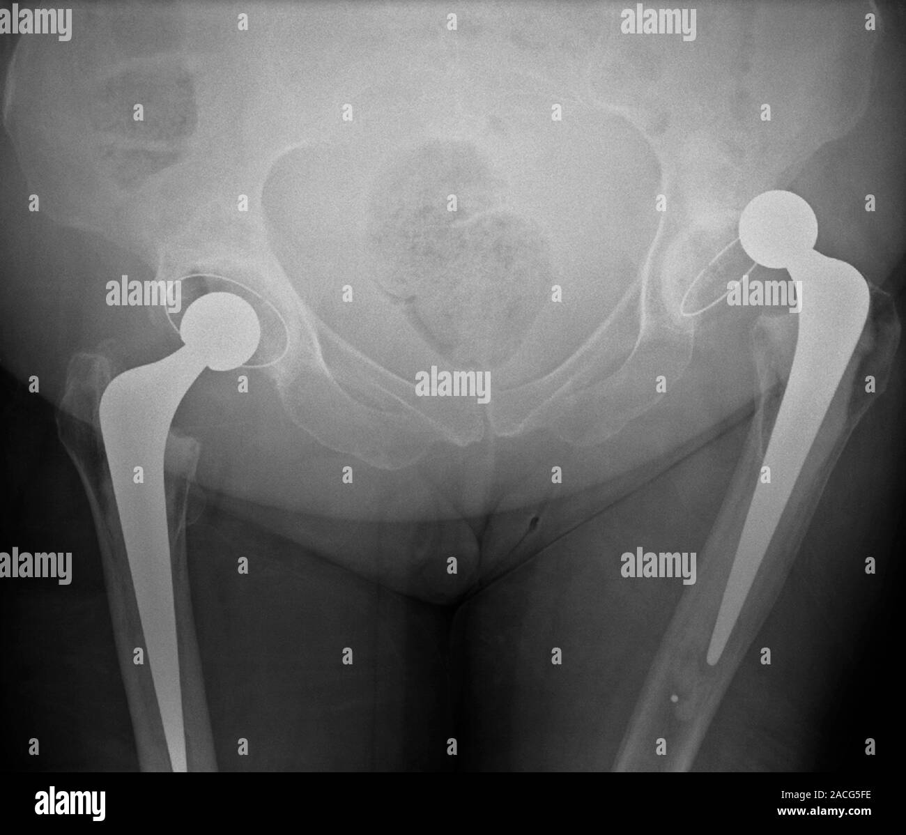 Dislocated hip replacement. Frontal Xray of the pelvis of a patient