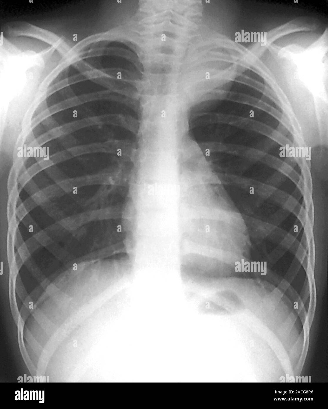 X-ray (front view) of the chest of a young male patient, showing a ...