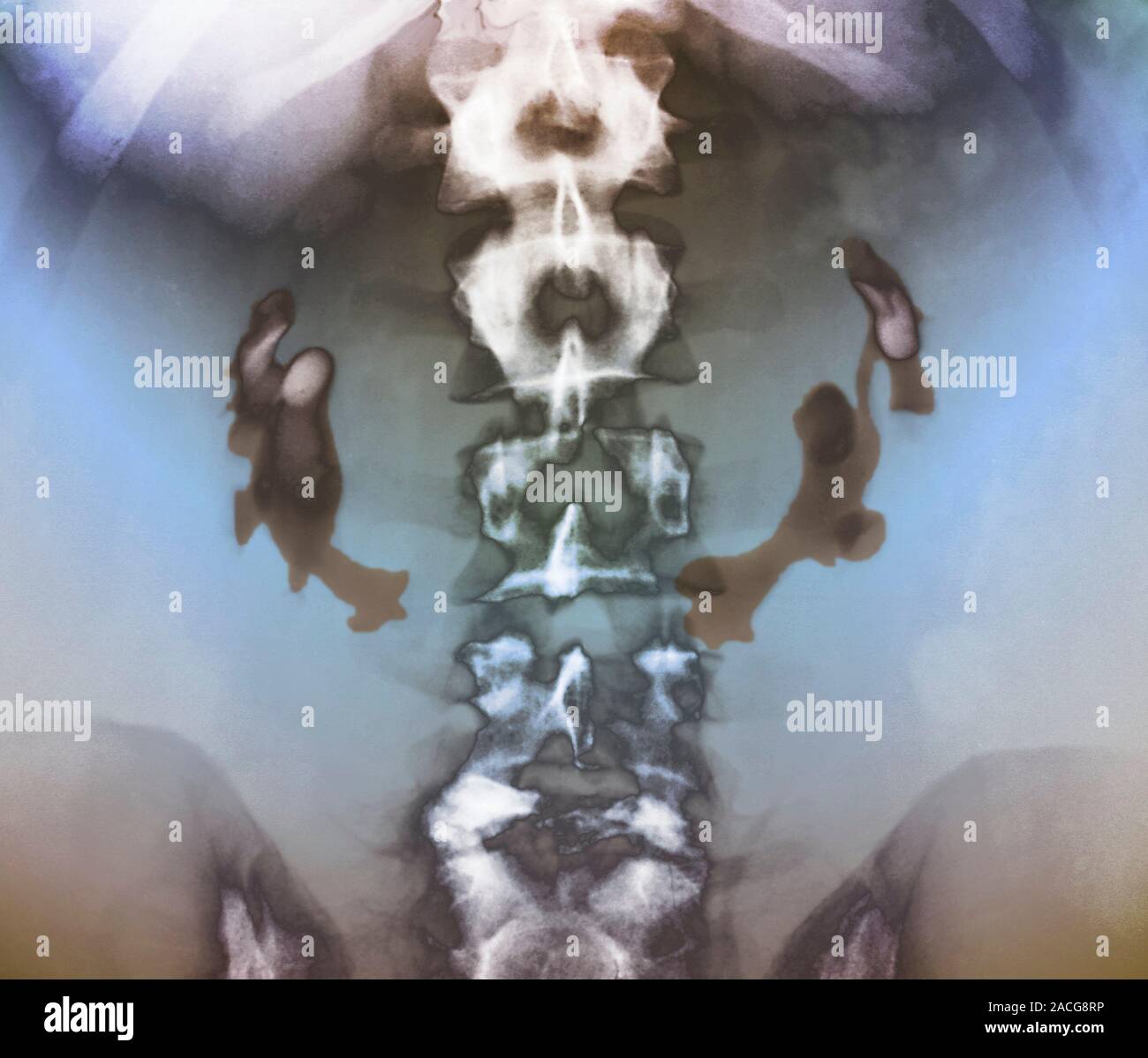 Coloured urogram (Xray) of the abdomen in a young patient, showing the