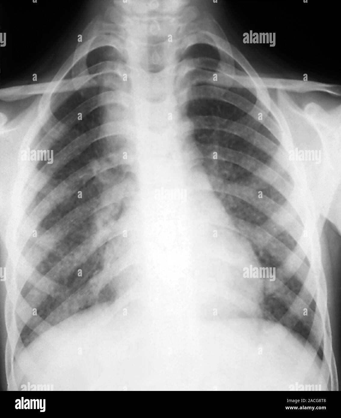 Xray of the chest of a patient, showing enlarged lymph nodes (at