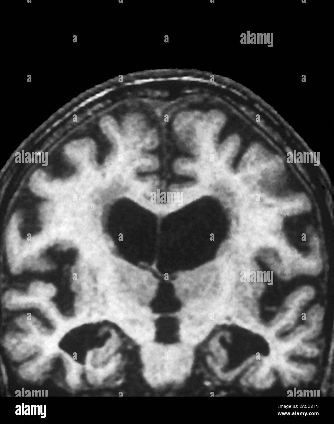 Magnetic Resonance Imaging (MRI) scan in coronal view through the brain ...