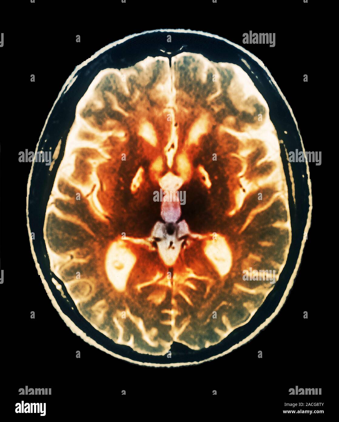 Гипоксическая энцефалопатия на мрт. Аноксическое поражение мозга. Аноксическое поражение головного мозга это. Аноксическое поражение головного мозга это. Органические заболевания головного мозга список.