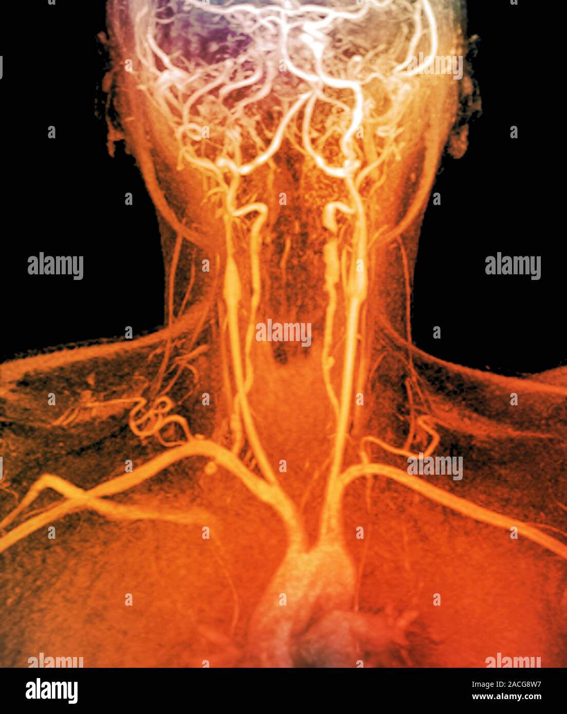 Coloured Magnetic Resonance Imaging (MRI) angiography scan of the neck ...