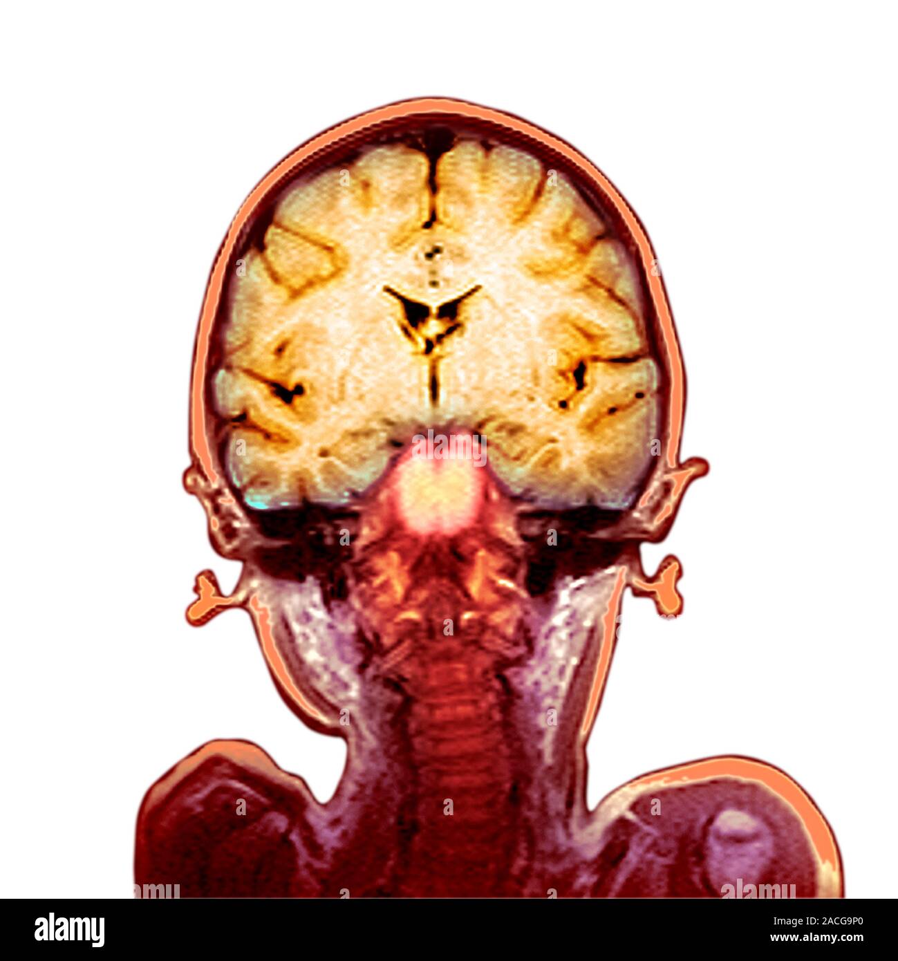 Child's brain. Coloured magnetic resonance imaging (MRI) scan of an ...