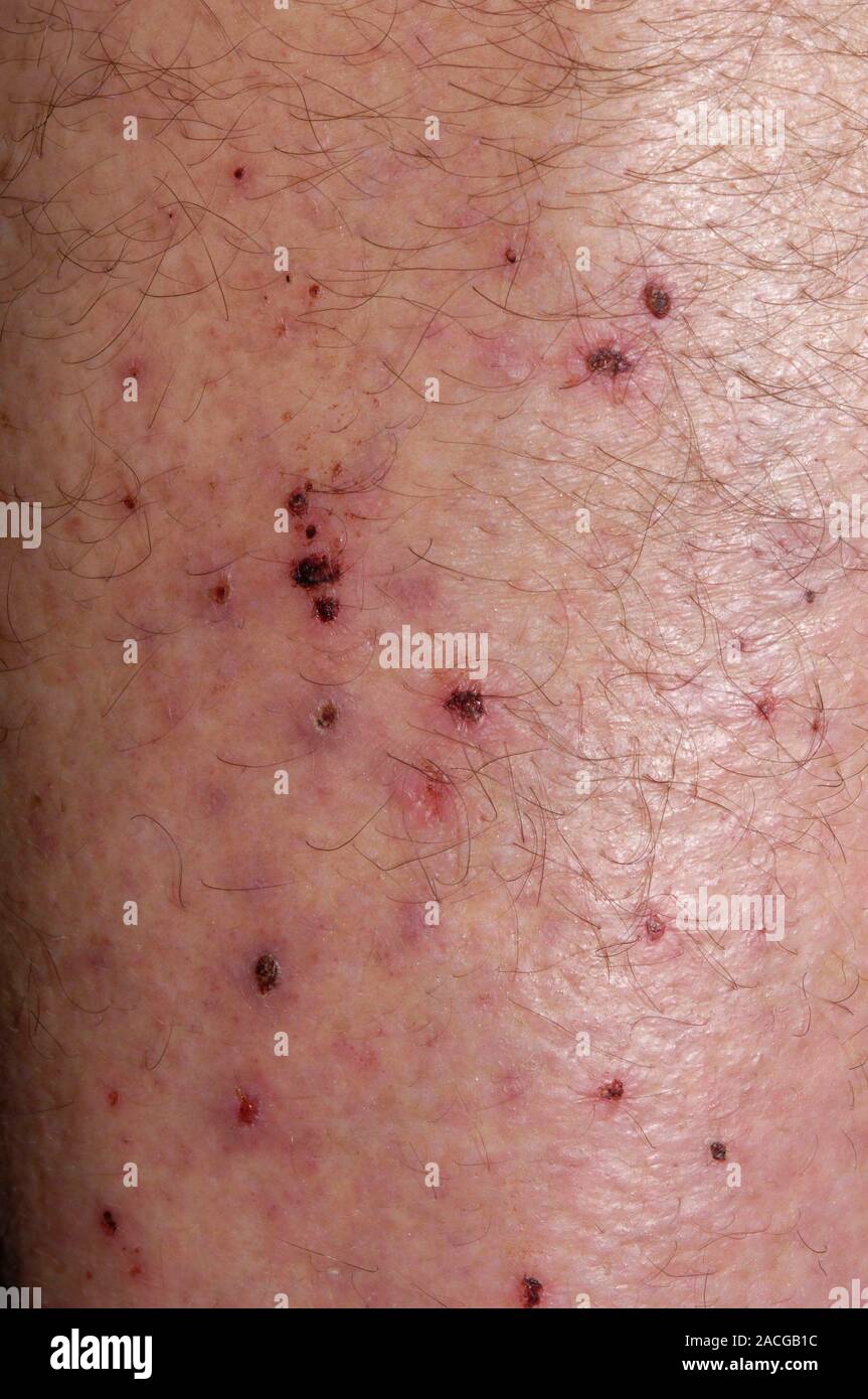Closeup of the skin of the shin in a 59 year old male patient, with