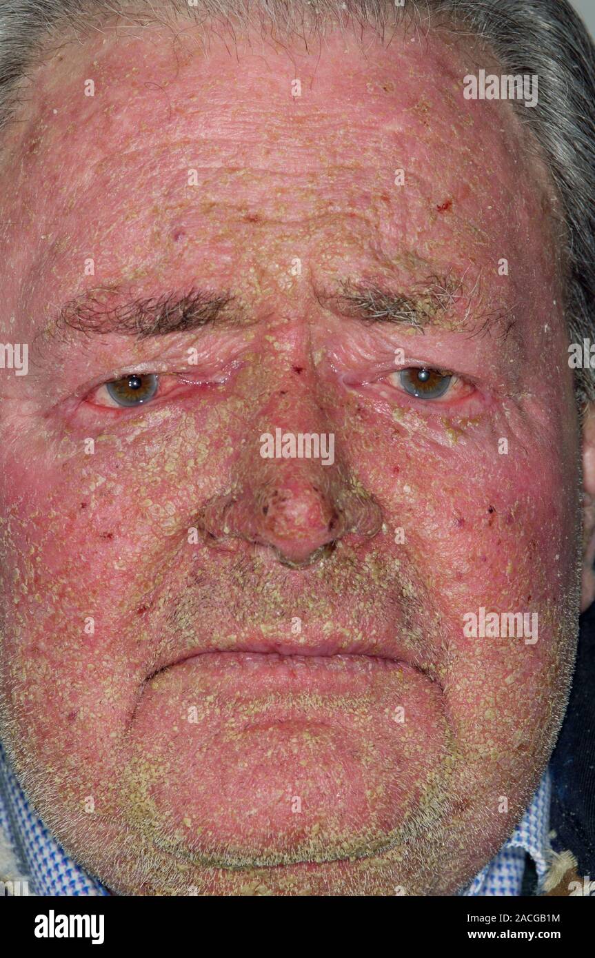 Face of an 85 year old male patient, showing exfoliative dermatitis (ED