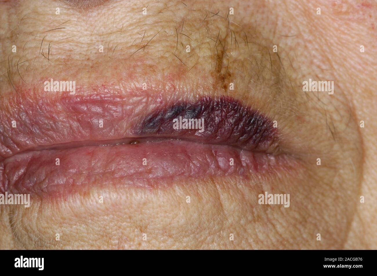 Spontaneous bruise (haematoma) on the lip of an 84 year old female