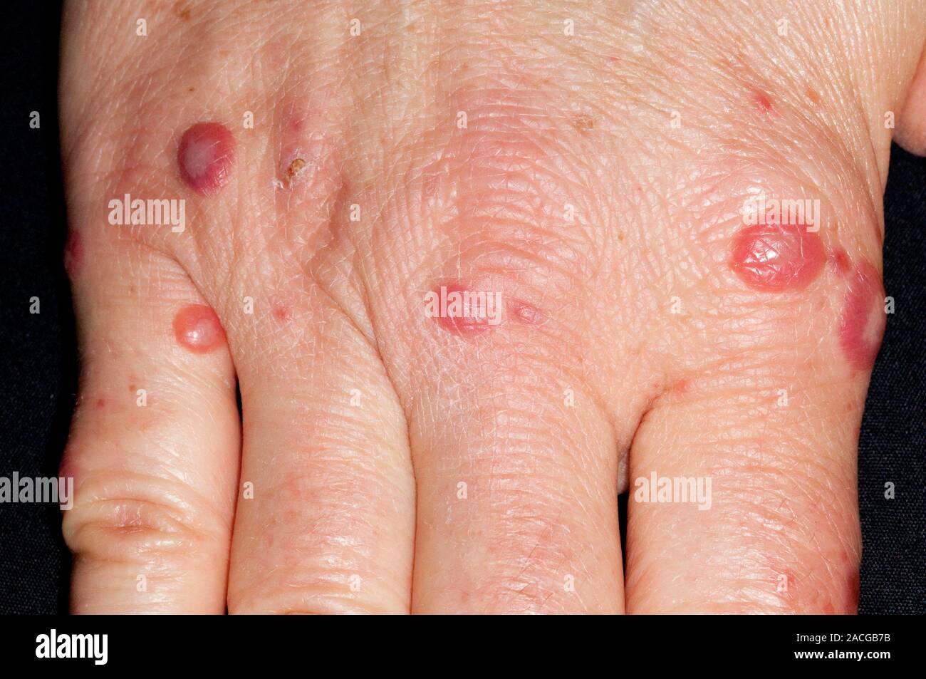 Lesions on the hand of an adult patient, showing hand, foot and mouth
