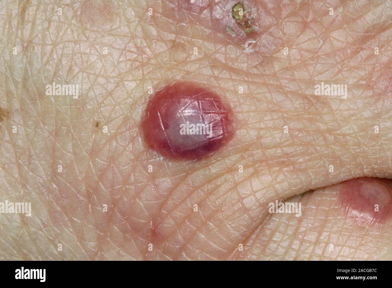 Closeup of lesions on the hand of an adult patient, showing hand, foot