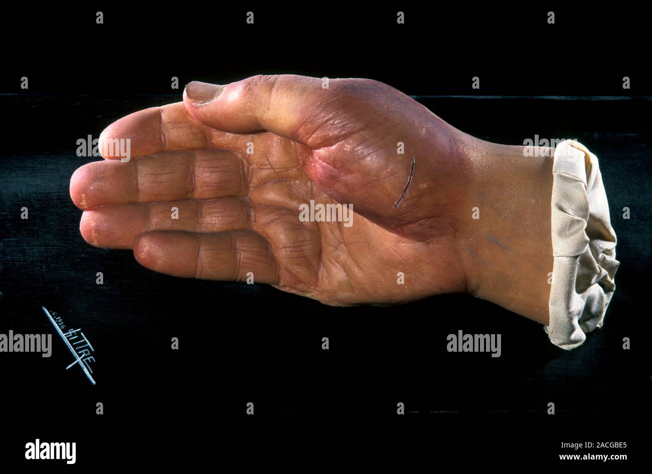 Erysipeloid skin infection model. Wax model of a human hand showing the redness and oedema (swelling) caused by an erysipeloid (Erythema serpens) infe Stock Photo
