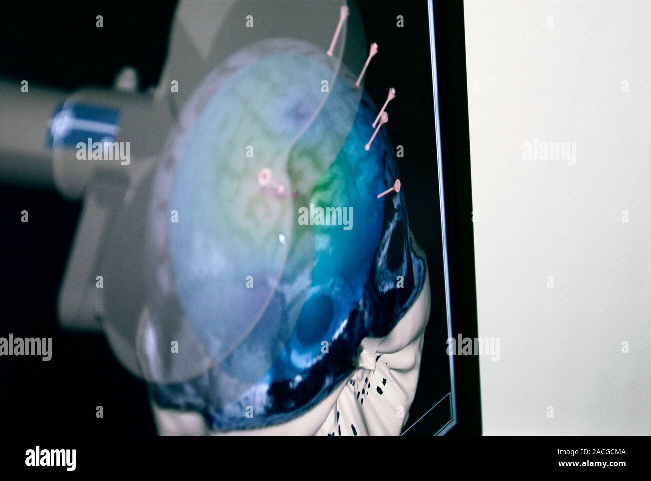 therapy for depression. Computer screen showing the position