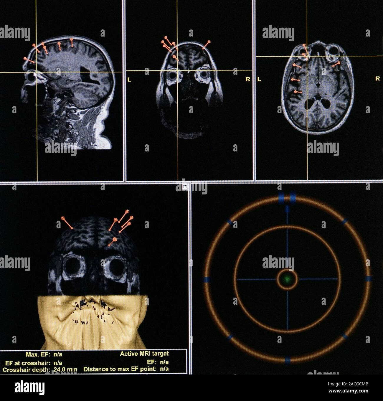 therapy for depression. MRI brain scans of a patient taken