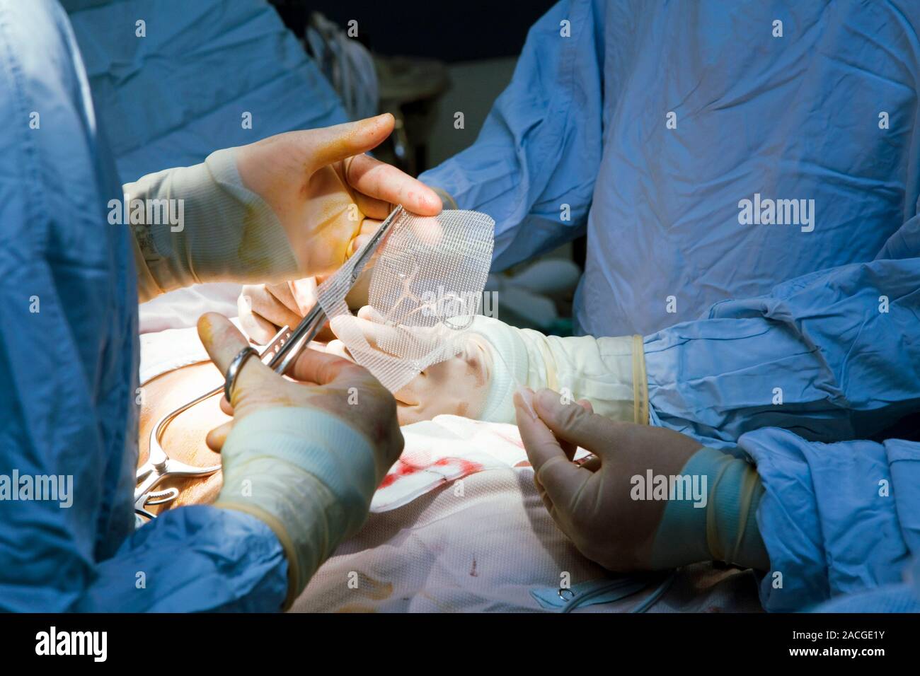 Hernia operation. Surgeon cutting a dressing to put on the wound left