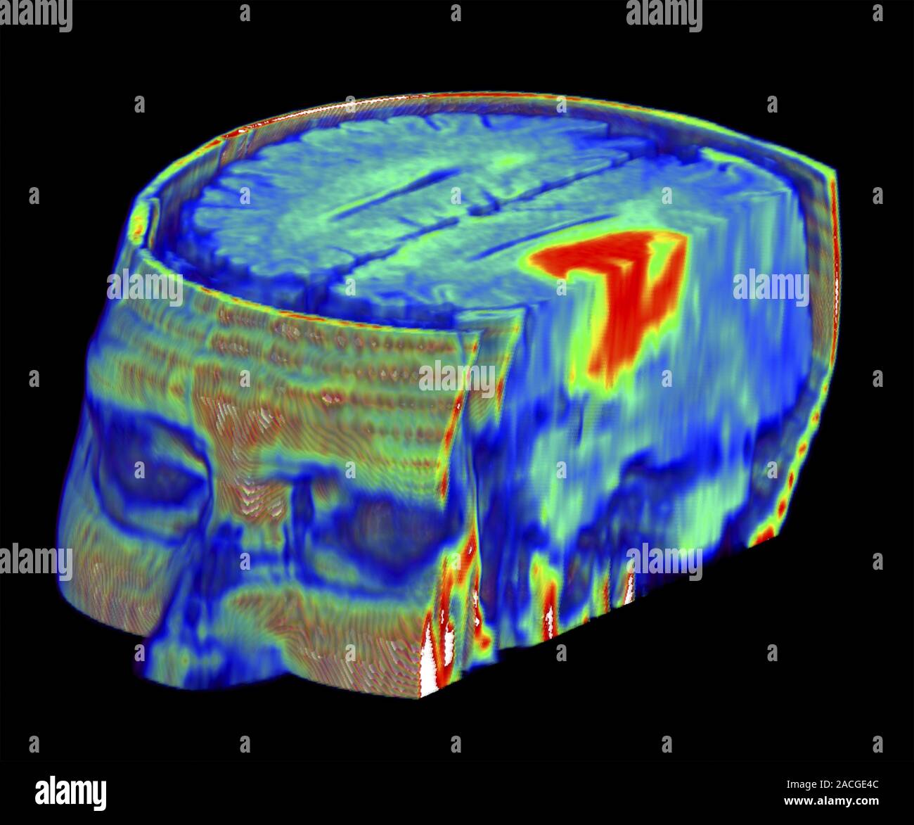 Brain tumour. Coloured three-dimensional model of a male head, made up ...