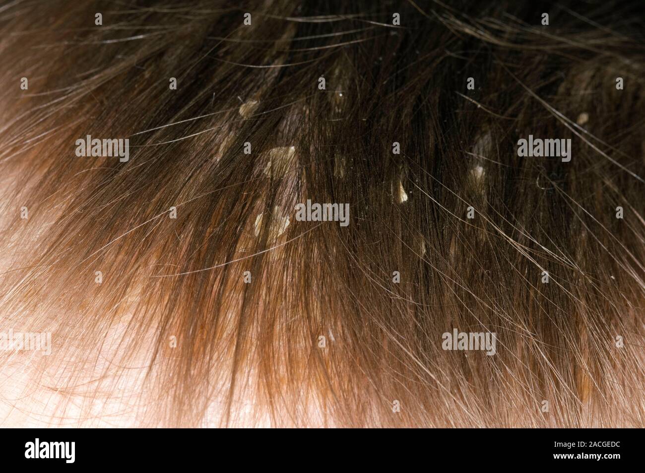 Skin scales in the hair of a six month old female patient due to cradle