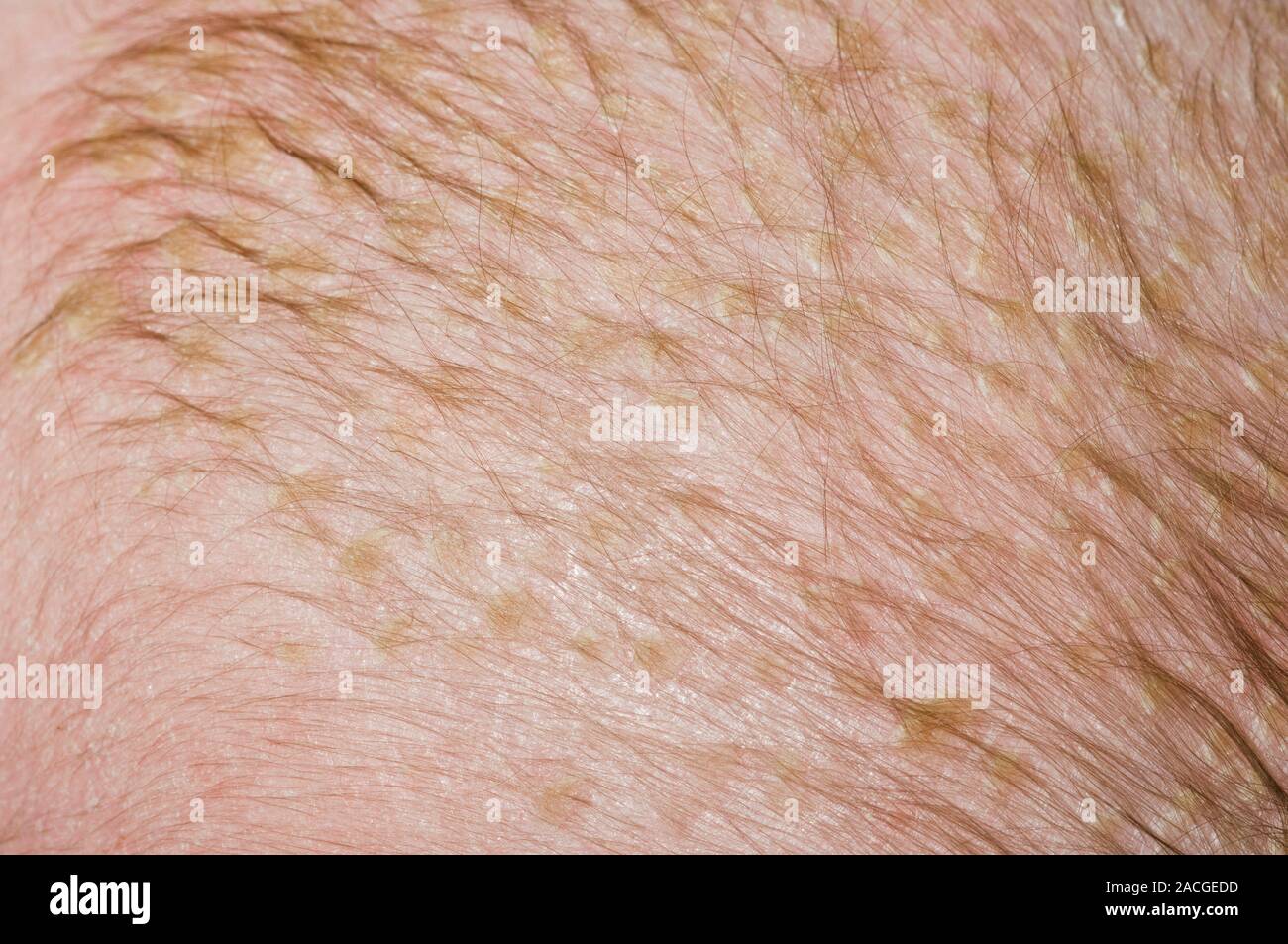Skin scales on the scalp of a six month old male patient due to cradle