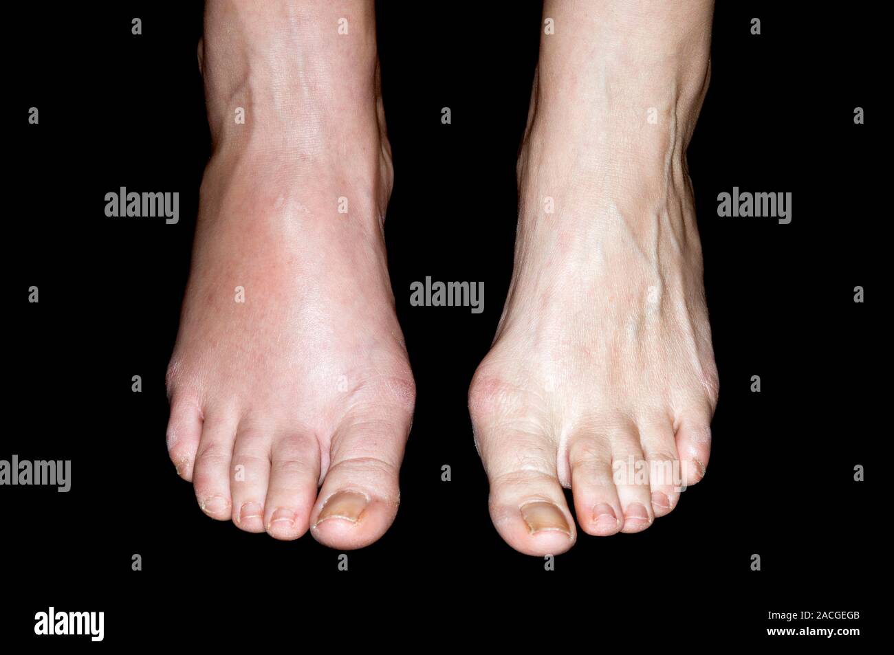 Feet of a 45 year old female patient, showing swelling (at left) due to