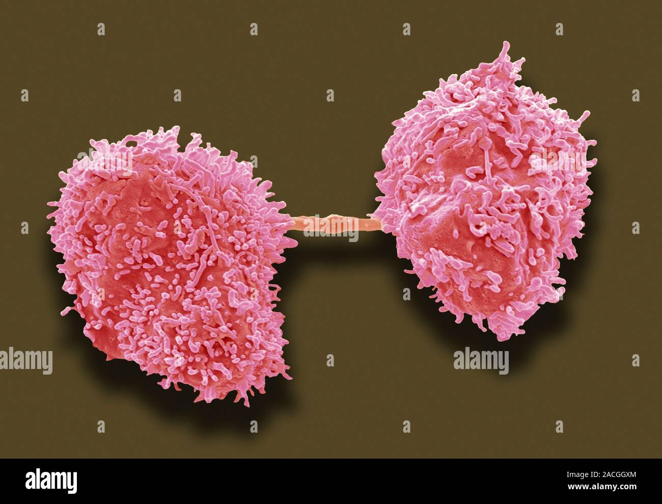 Dividing cancer cells, coloured scanning electron micrograph (SEM). At ...