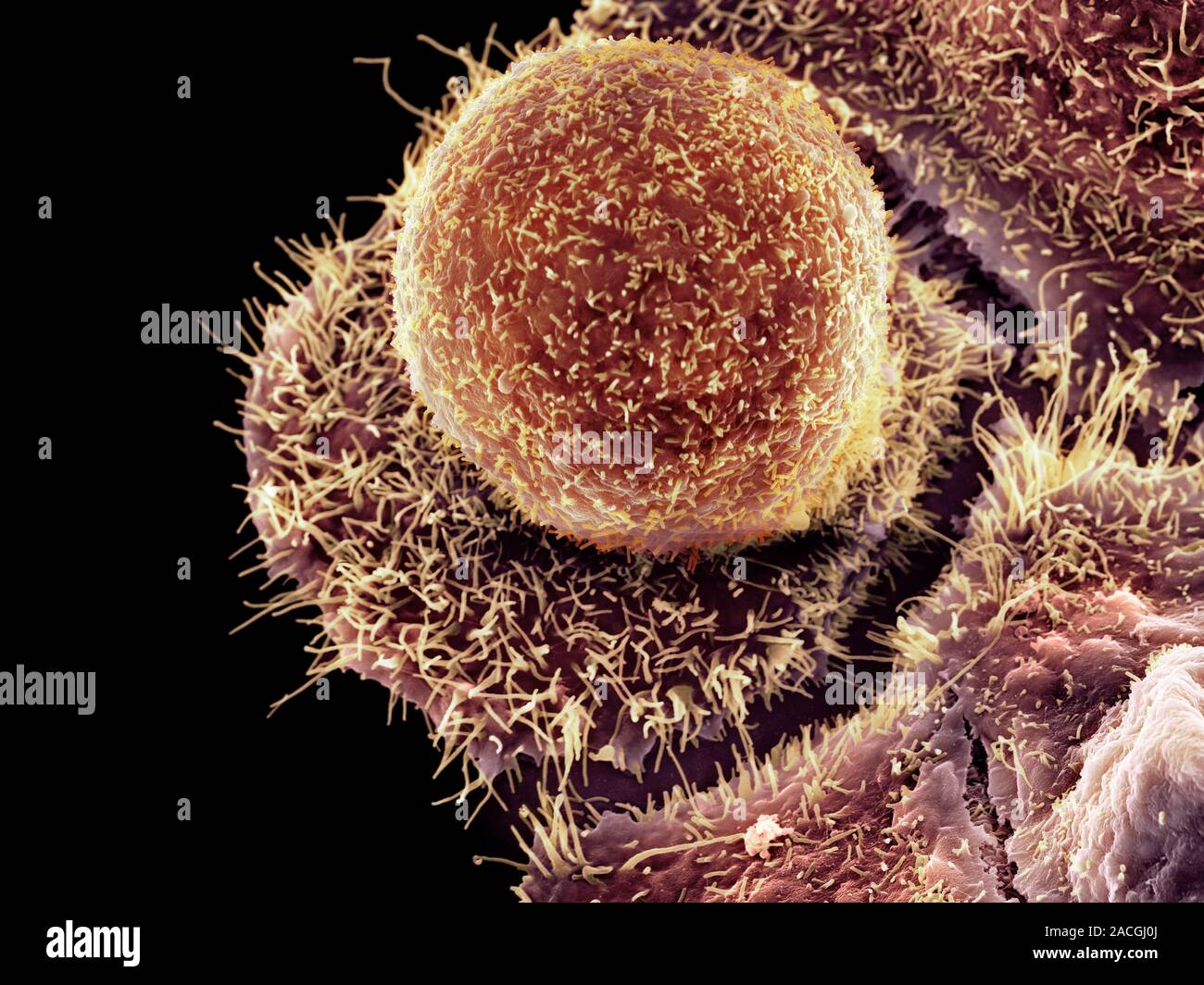 Chlamydia Infection Coloured Scanning Electron Micrograph Of A Cultured Human Cervix Cancer