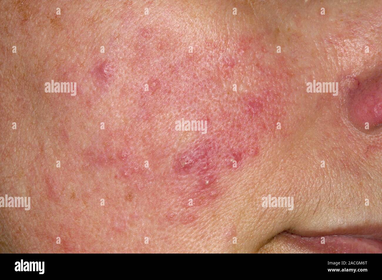 Acne rosacea on the cheek of the face in a 44 year old female patient ...
