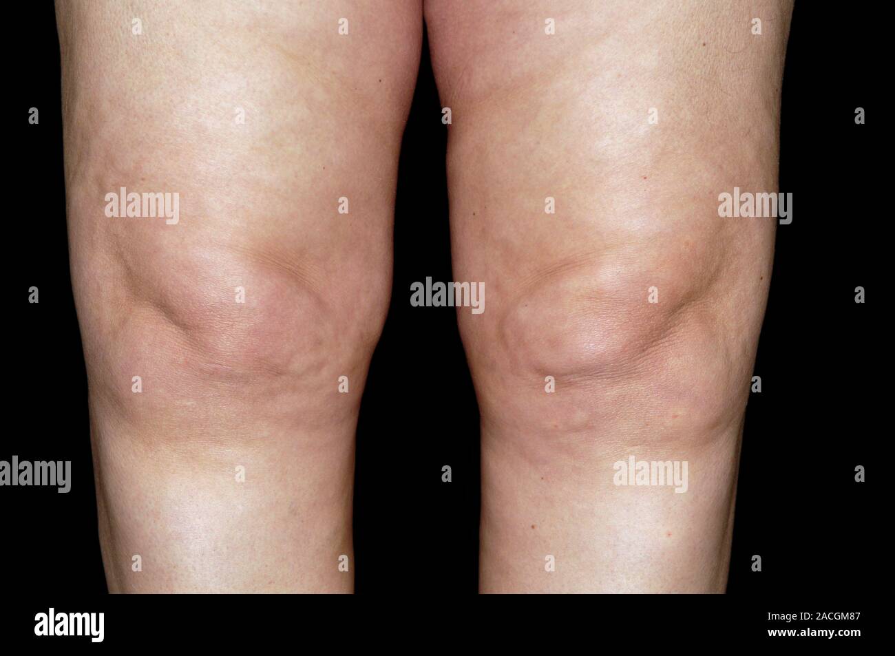 Swollen knees of a 51 year old female patient with osteoarthritis