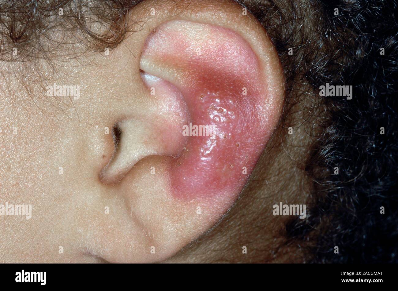 close-up-of-a-red-and-inflamed-lesion-on-the-pinna-of-the-ear-in-a-5