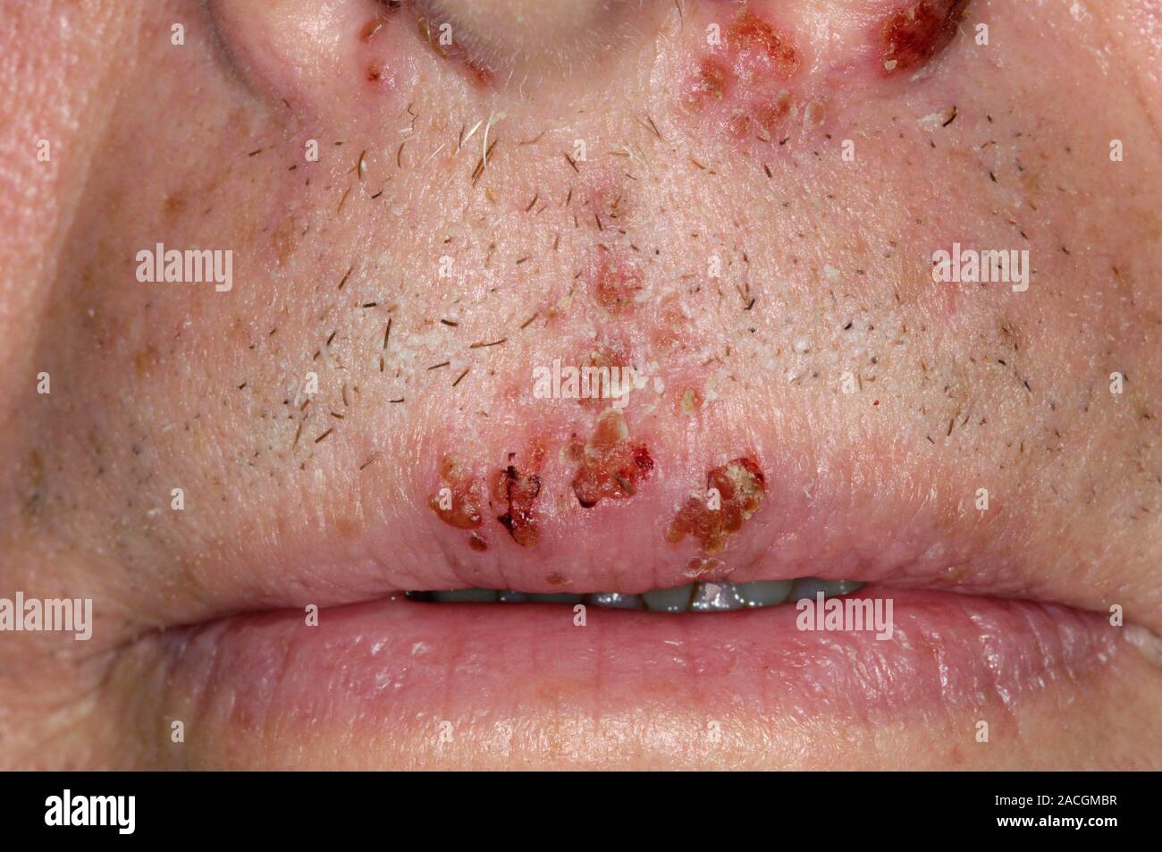 Closeup of cold sore lesions on the upper lip of a 65 year old male