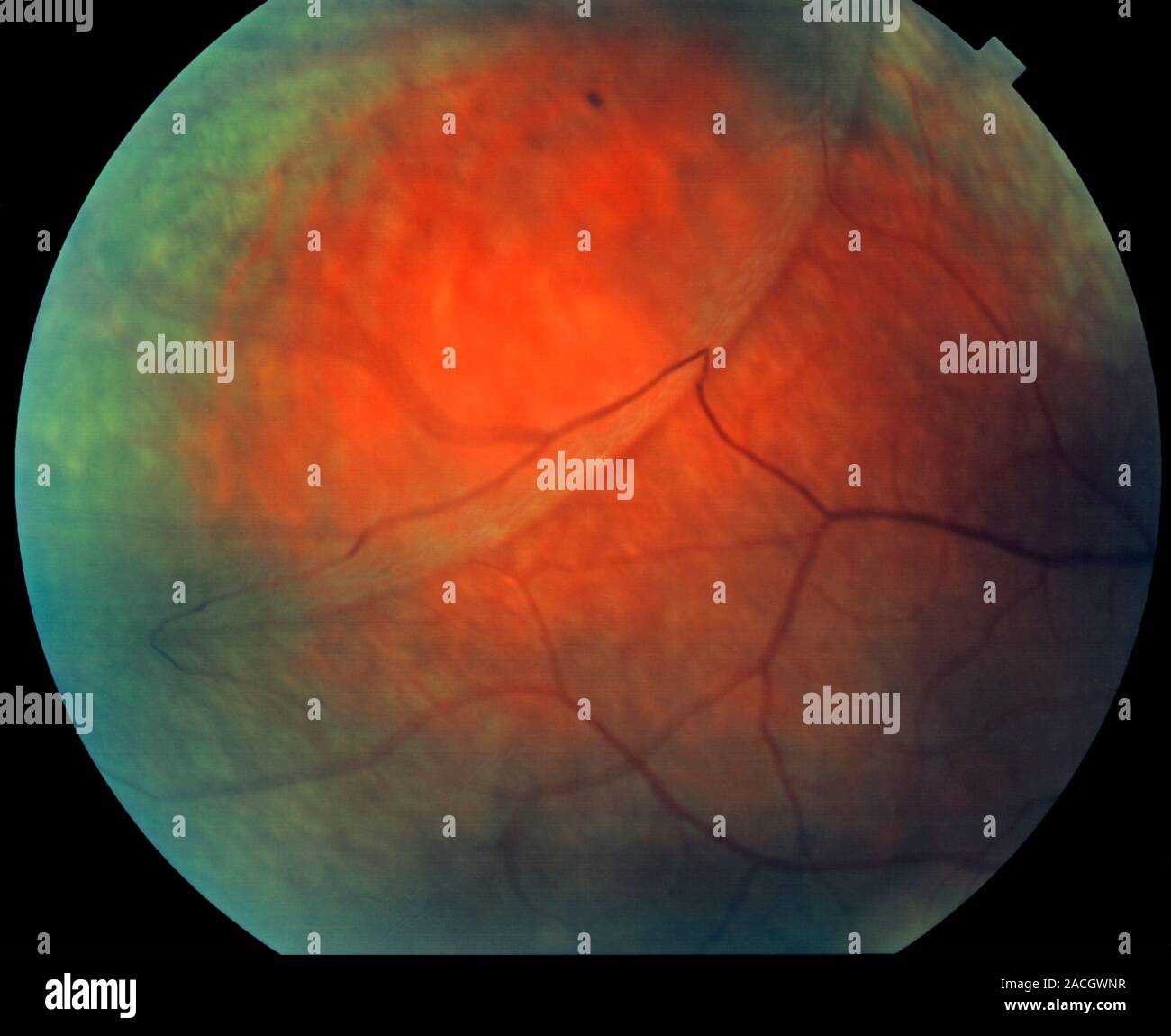 Retinoschisis, the splitting of the eye's retina into two layers Stock