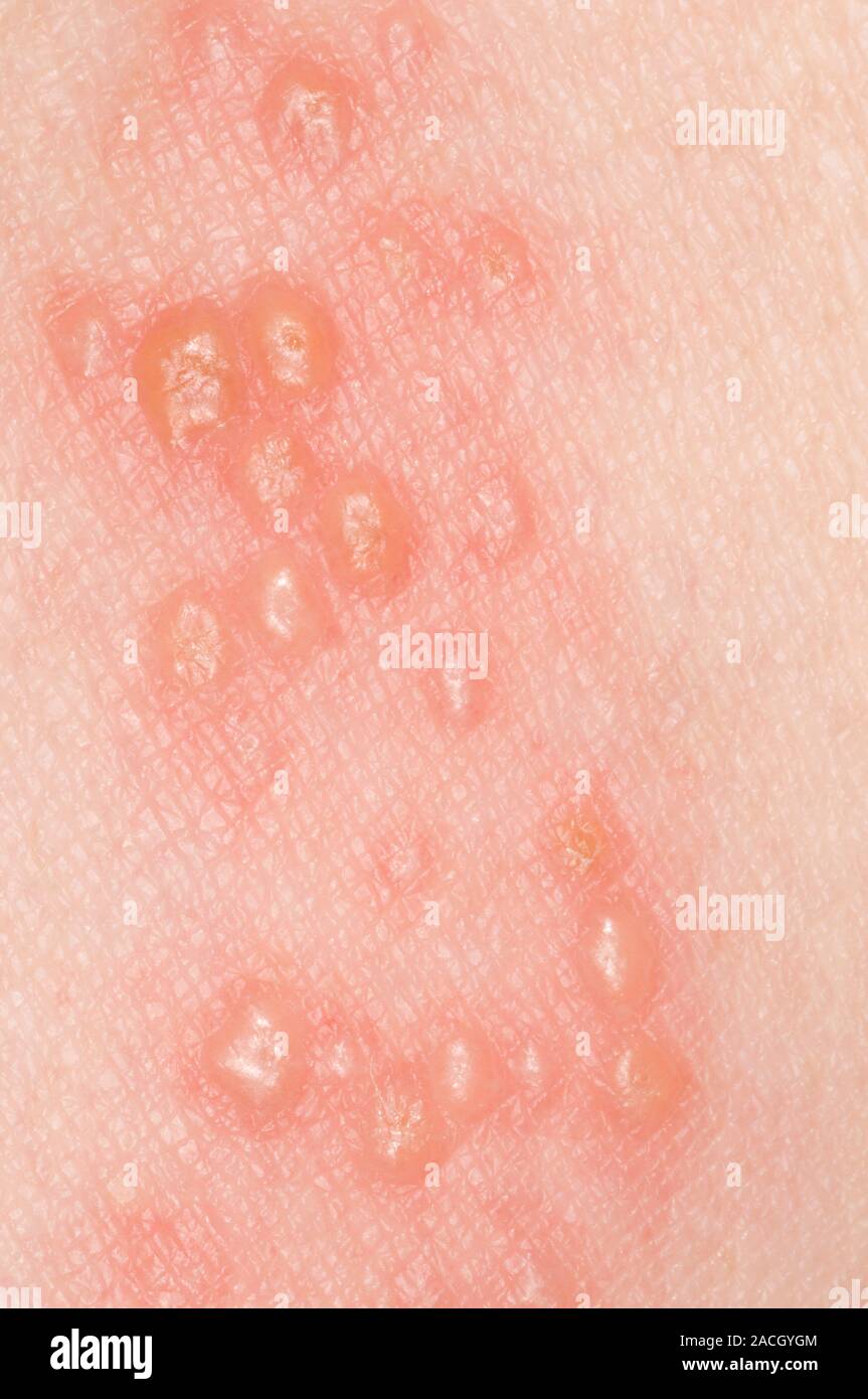 Shingles, or herpes zoster, rash on the skin of a 61 year old man ...